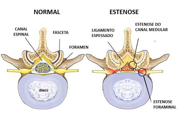 Estenose Lombar: tipos de dor lombar