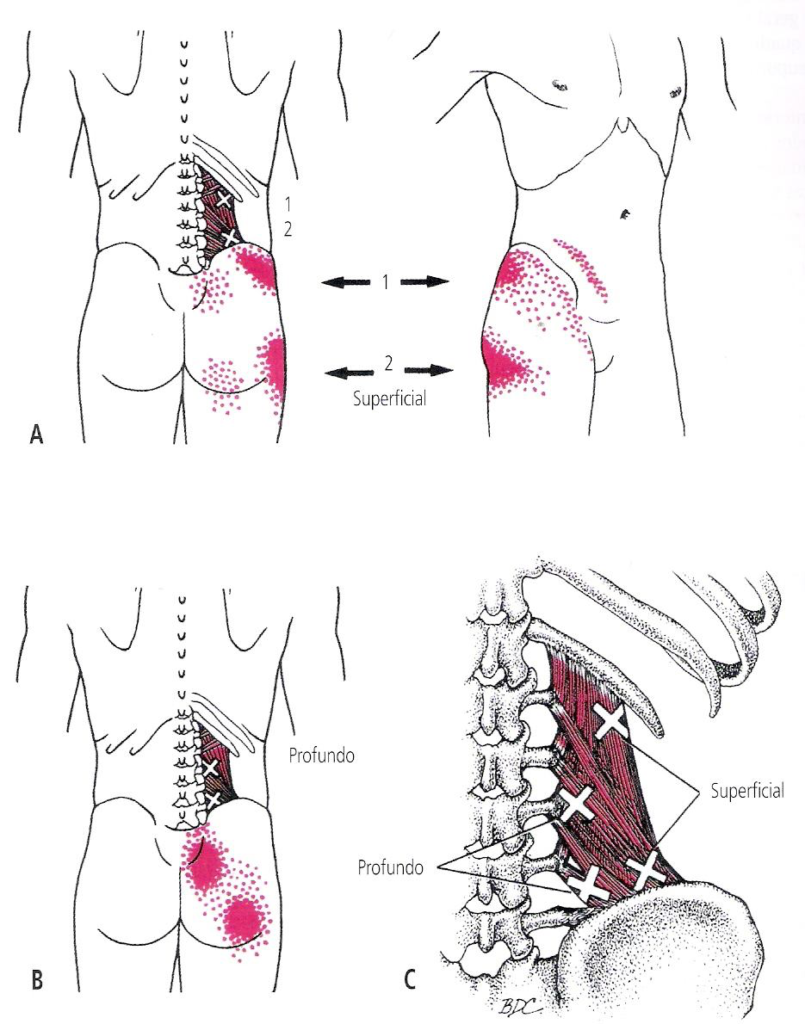 Disco Miofascial: tipos de dor lombar