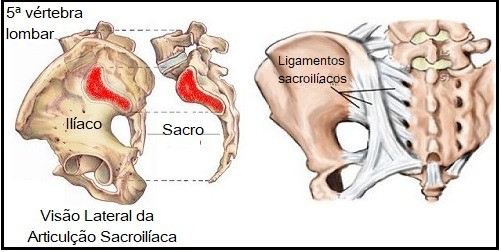 SACROILEÍTE: tipos de dor lombar