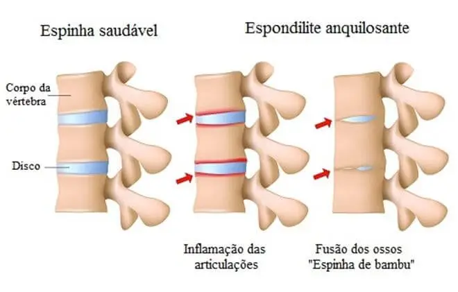 ESPONDILOARTROPATIA: tipos de dor lombar