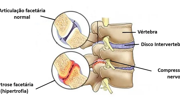 Síndrome Facetária: tipos de dor lombar