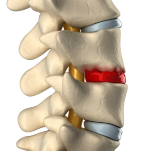 Degeneração de disco invertebrado: tipos de dor lombar